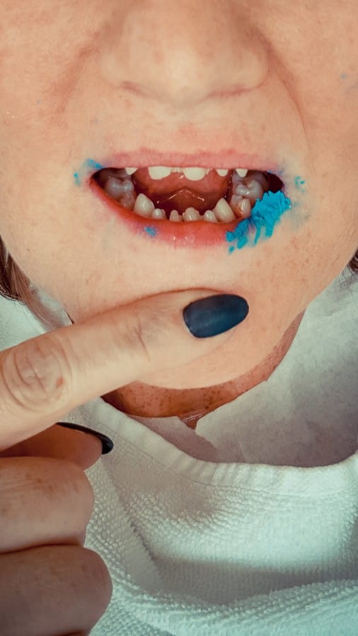 poliklinika bagatin_Dilled for veneers