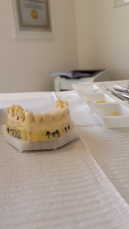 poliklinika bagatin_Veneers