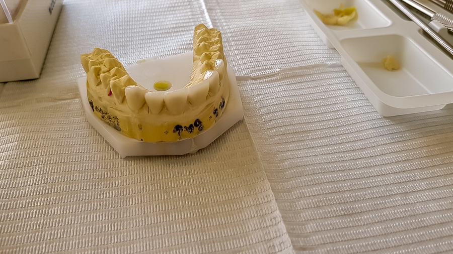 poliklinika bagatin_Veneers Top Row