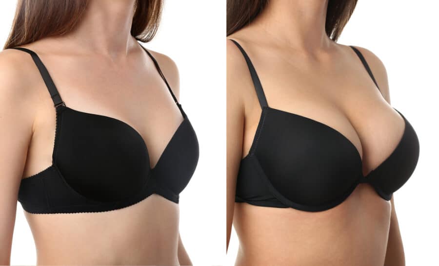 Breast Surgery In Istanbul