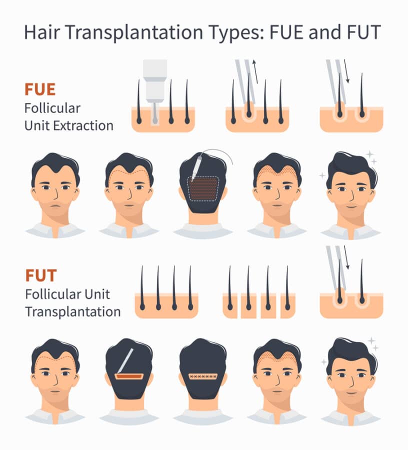 Hair Transplants In Istanbul