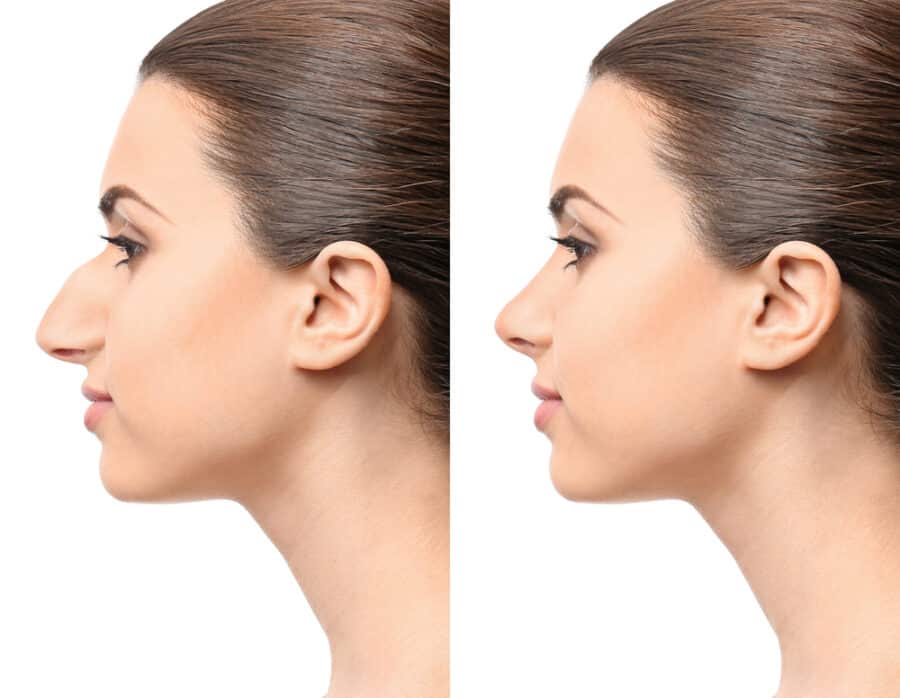 Young woman before and after rhinoplasty in Istanbul